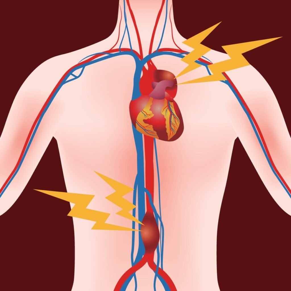 Aneurisma de Aorta