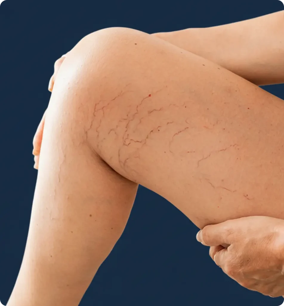 muslos con varices en rama imagen