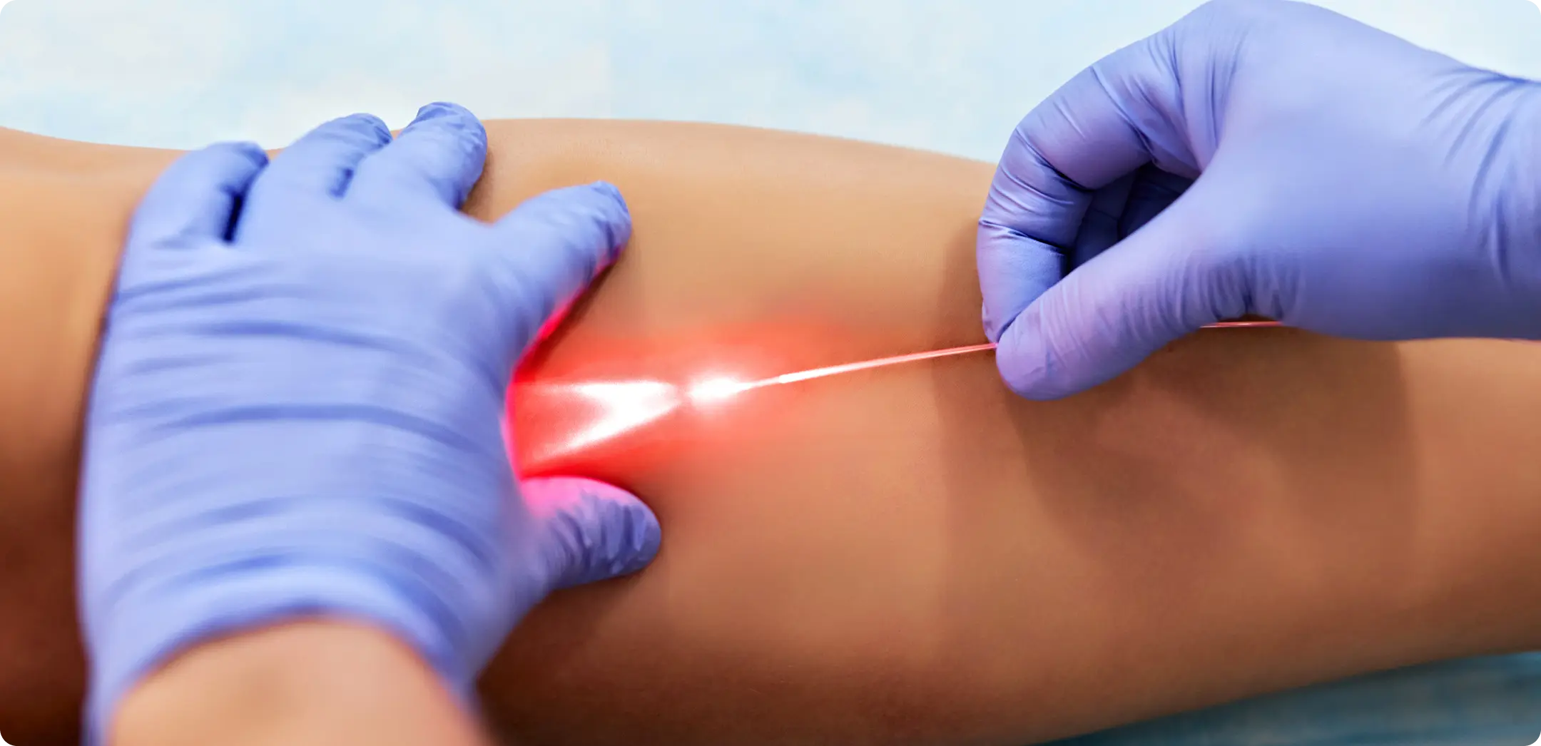 procedimiento vascular imagen